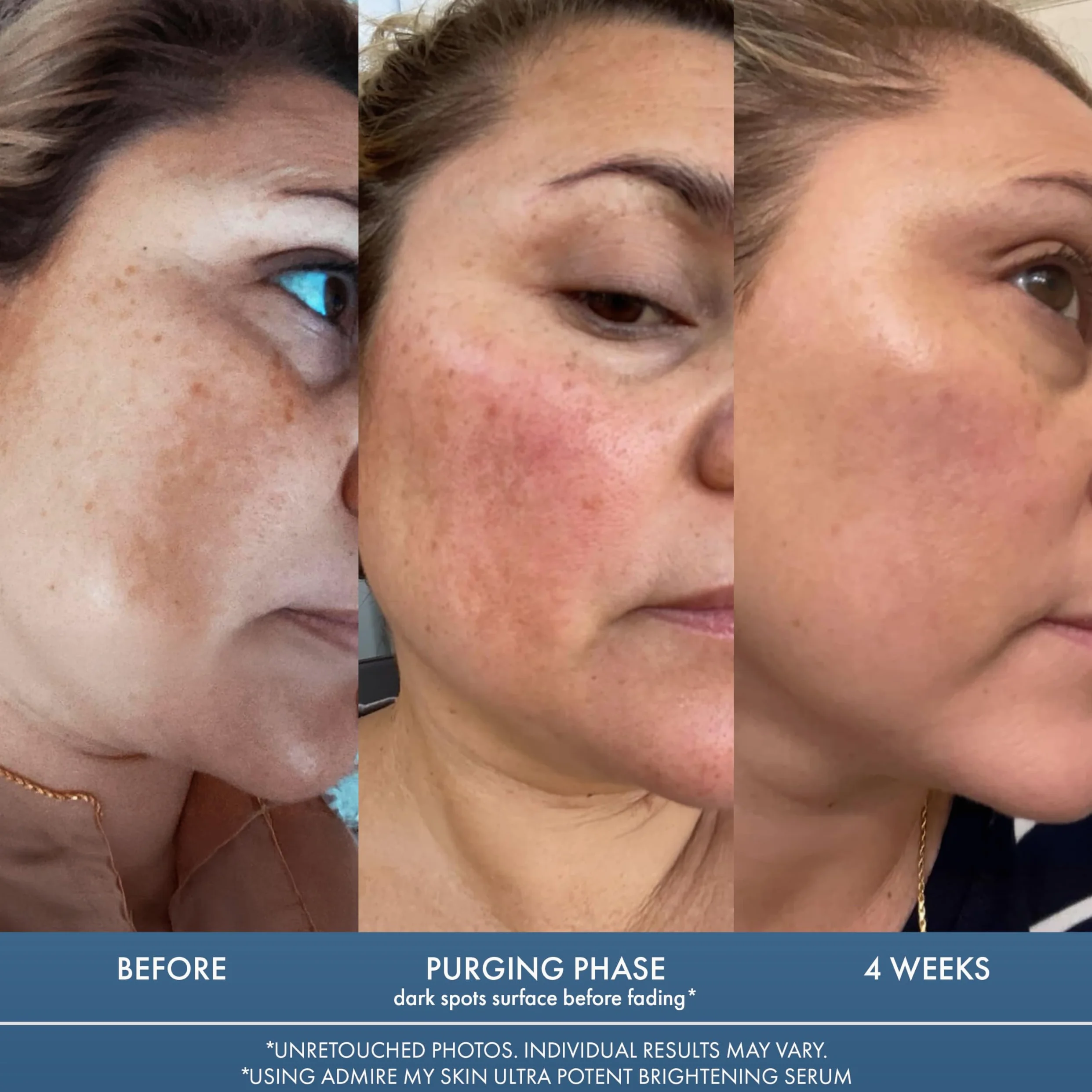 Admire My Skin Serum rozjaśniające, leczenie przebarwień na ciemne plamy i nierówny odcień skóry - serum z witaminą C z kwasem kojowym dla kobiet i mężczyzn, serum z kwasem azelainowym do leczenia