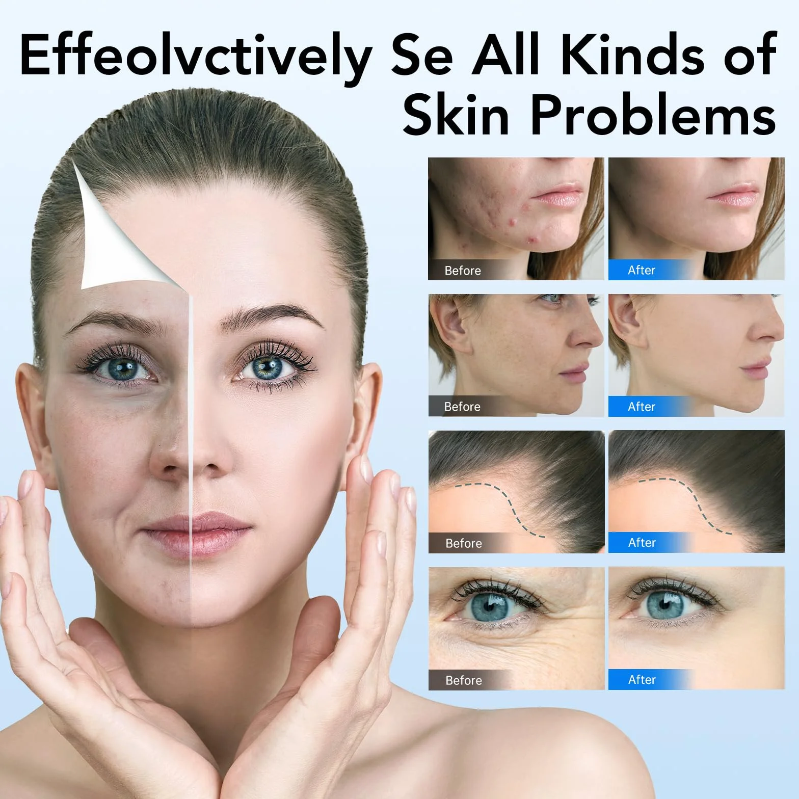 Dr.Pen A6 mikronkowy długopis do twarzy i ciała Mirco Needling Derma Pen do serum blizn z 5 prędkościami, regulowana głębokość, z 2 bateriami zapasowymi i 10 wkładami, 36-pinowa, przewodowa i