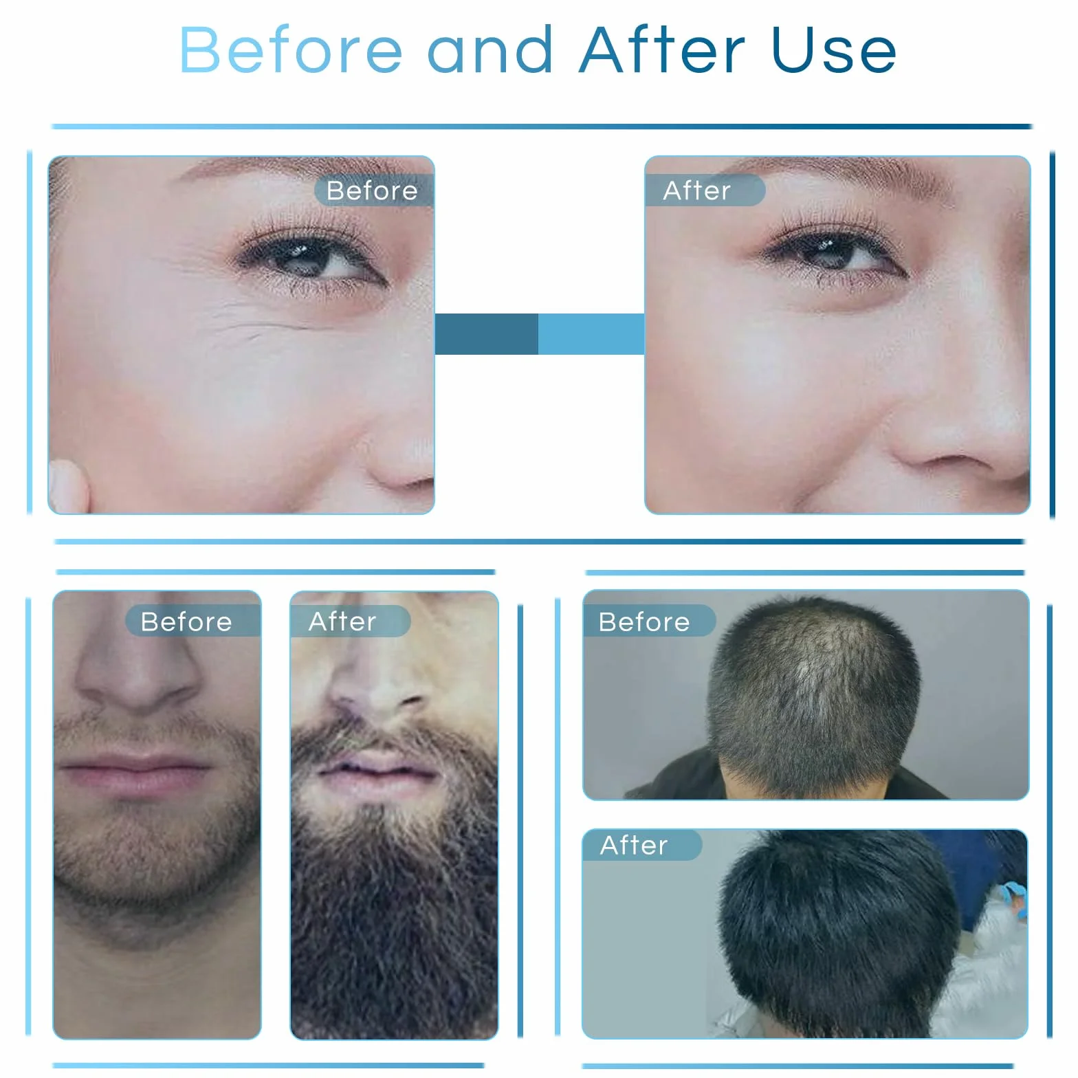 Derma Stamp, regulowany długopis do mikroigłowania 0-3 mm ze 140 pinami, profesjonalny Dermastamp Microneeedling Pen Derma Pen Hair Broda Growth dla mężczyzn i kobiet