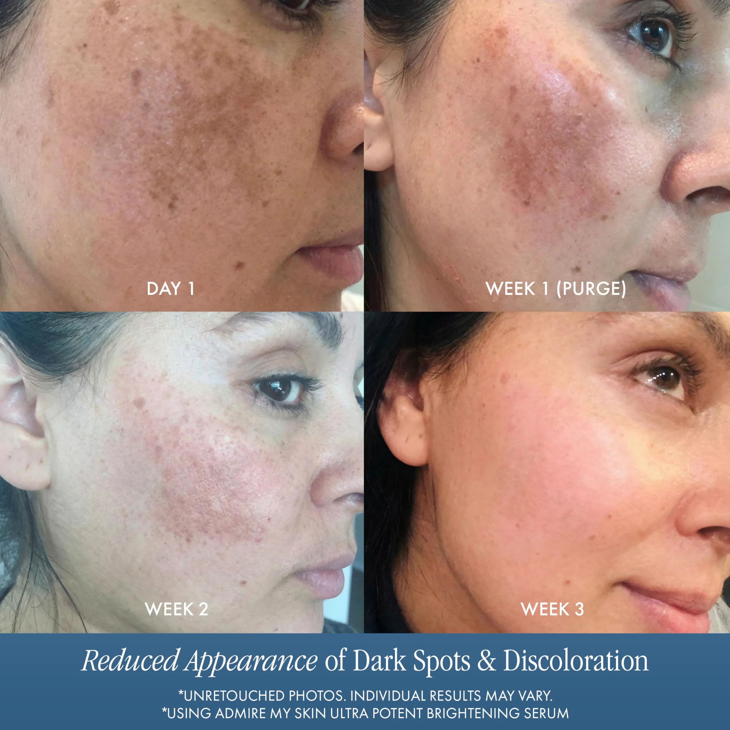 Admire My Skin Serum rozjaśniające, leczenie przebarwień na ciemne plamy i nierówny odcień skóry - serum z witaminą C z kwasem kojowym dla kobiet i mężczyzn, serum z kwasem azelainowym do leczenia