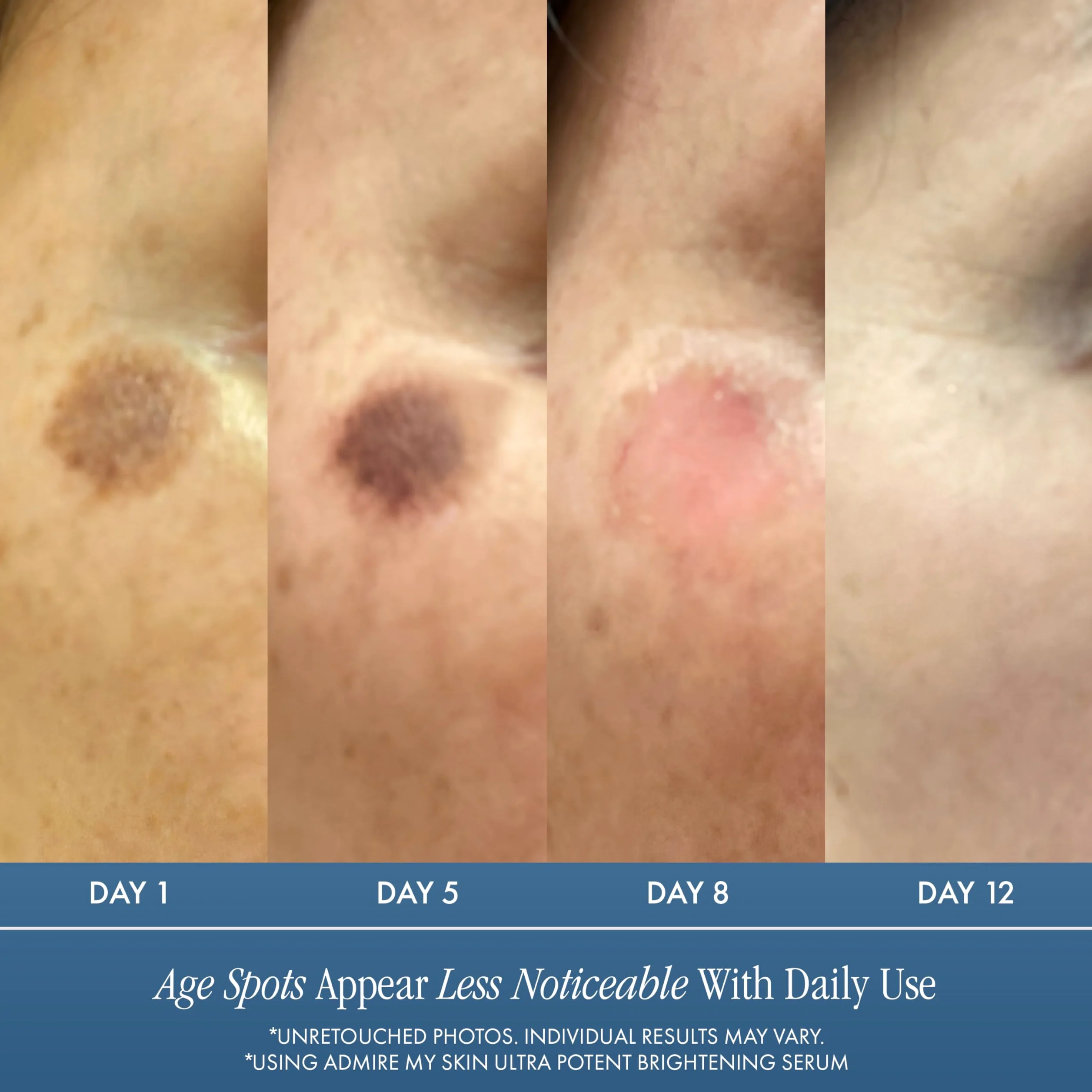 Admire My Skin Serum rozjaśniające, leczenie przebarwień na ciemne plamy i nierówny odcień skóry - serum z witaminą C z kwasem kojowym dla kobiet i mężczyzn, serum z kwasem azelainowym do leczenia