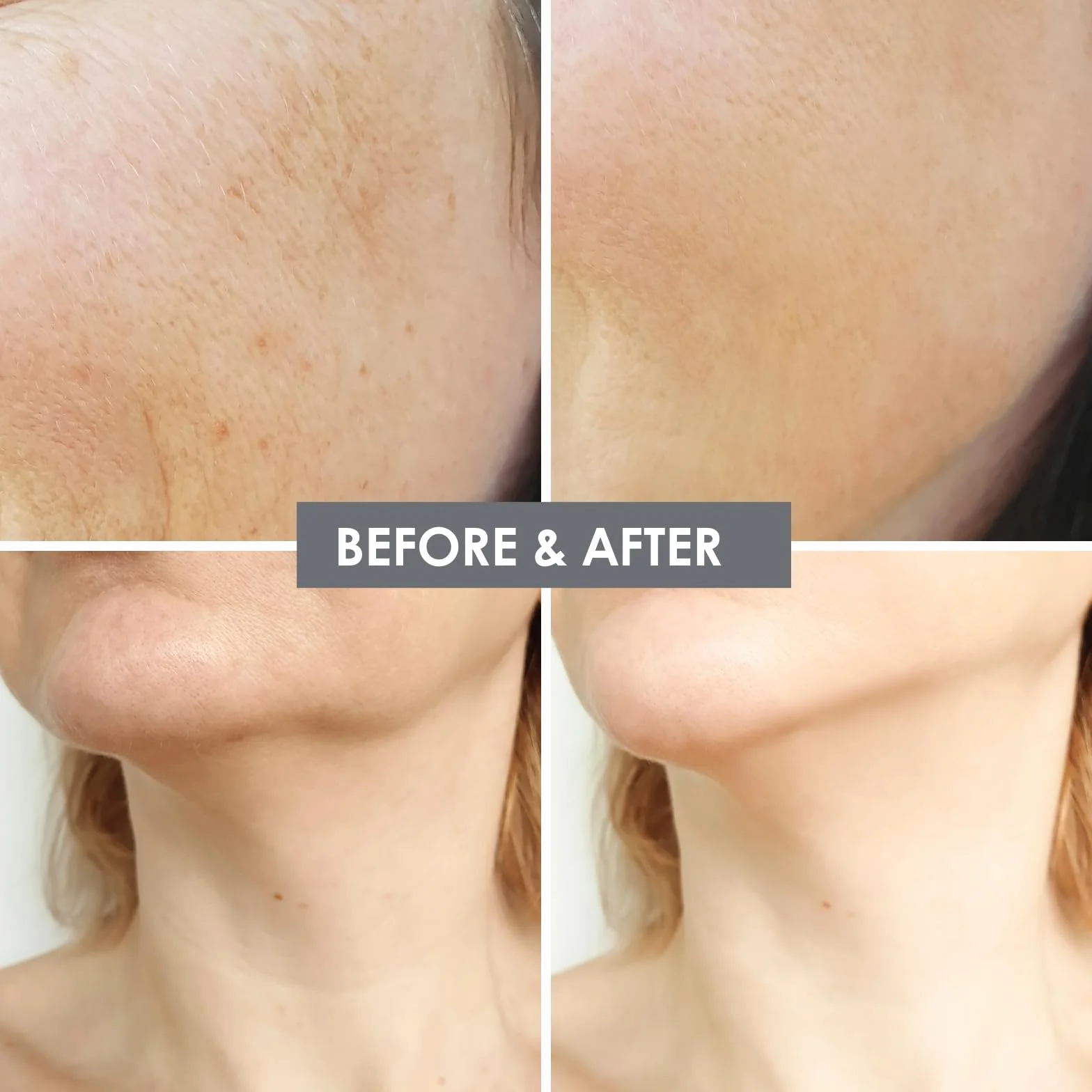 Microneedling zestaw do infuzji, system infuzyjny z igłą Hydra 0,5 mm, 1 szt., 4 zapasowe igły i 5 ampułek z serum przeciw starzeniu się skóry 5 ml, roztwór zapobiegający starzeniu się skóry