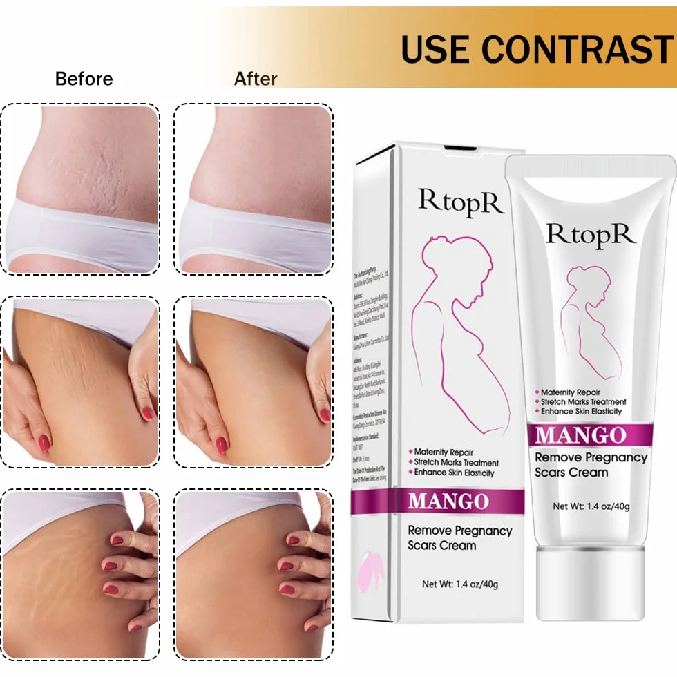 Krem na rozstępy, krem do usuwania blizn, krem do naprawy rozstępów, blizn ciążowych, krem Stretch Marks Cream, 40 g