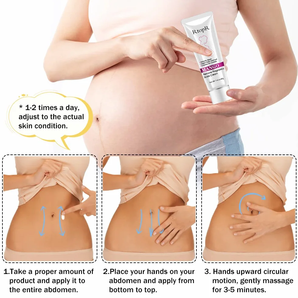 Krem na rozstępy, krem do usuwania blizn, krem do naprawy rozstępów, blizn ciążowych, krem Stretch Marks Cream, 40 g