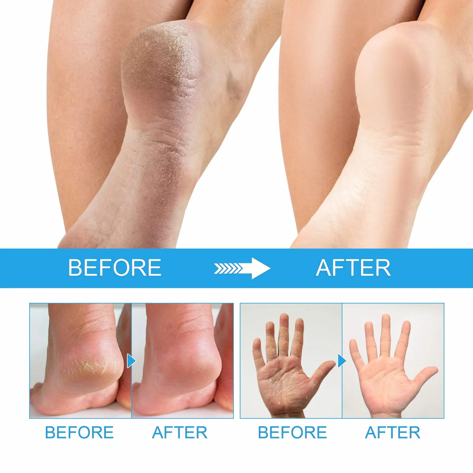 Urea Cream 2 szt. 40% krem mocznikowy, peeling i maść na pęknięcia, nawilżający, do dłoni, stóp, twarzy i ciała, usuwa obumarły naskórek